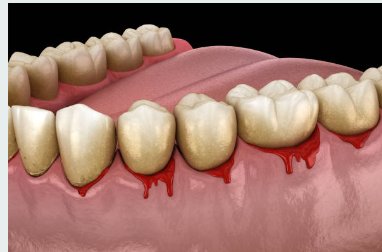 See How to treat and cure gum infections in your Mouth